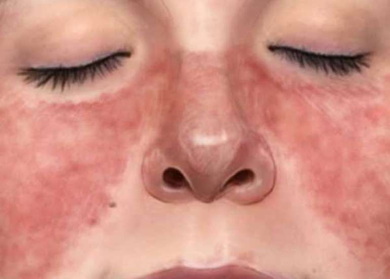 लुपस रोग के बारे में सब जाने : लक्षण, कारण, प्रकार और उपचार 