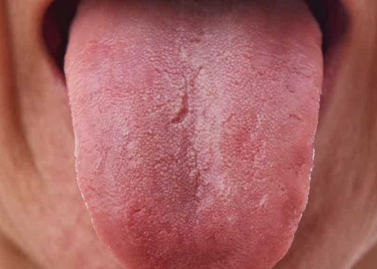 मैक्रोग्लोसिया क्या है? कारण, लक्षण और इलाज | Macroglossia in Hindi