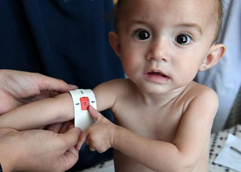 आधुनिक दुनिया की सबसे गंभीर समस्या – कुपोषण | Malnutrition in Hindi