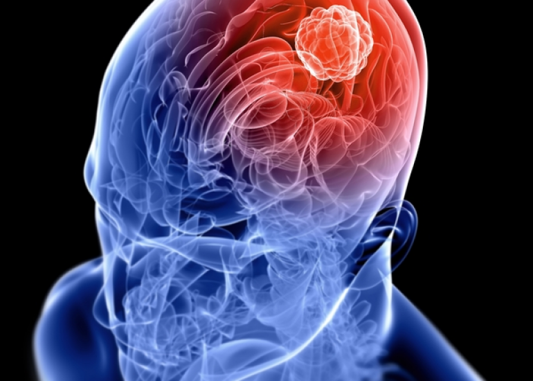 Management Strategies for Pediatric Brain Tumors: Surgery, Radiation, Chemotherapy, and Beyond