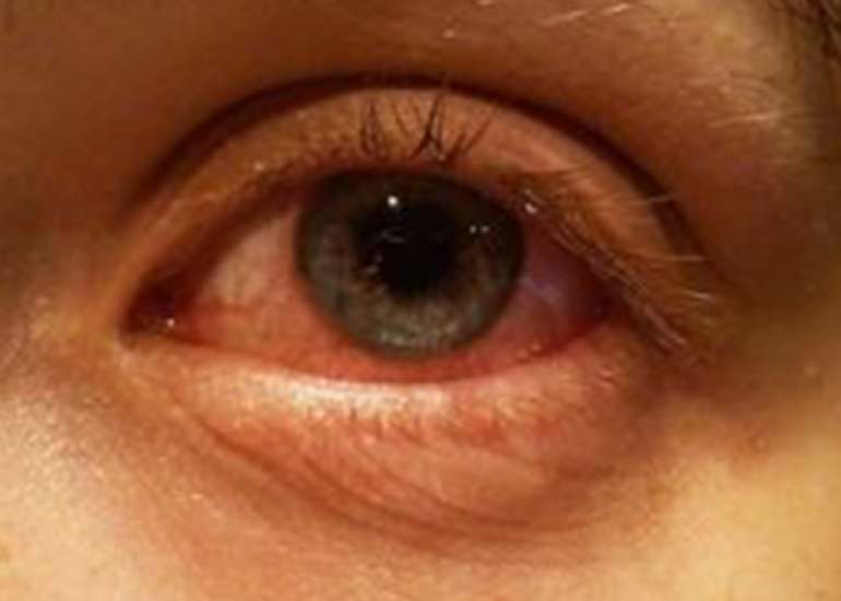 Is there a set algorithm or guideline for management of glaucoma?