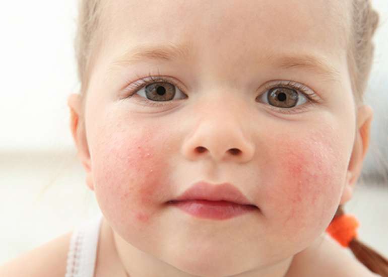 Mouth breathing and skin disease in children?