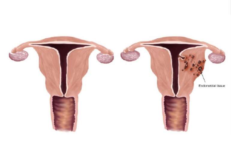 Medical vs. Surgical Approaches for the Conservative Management of Uterine Adenomyosis