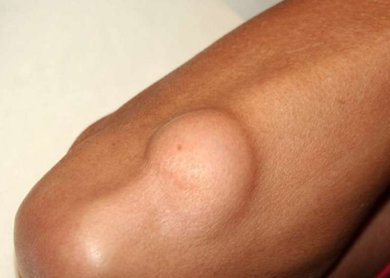 गांठ और बम्प्स क्यों होते हैं | Rashes, Bumps and Lumps in Hindi