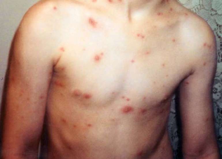 खसरा रोग क्या है? कारण, लक्षण, इलाज, घरेलु उपाय - सब जाने | Measles Meaning in Hindi