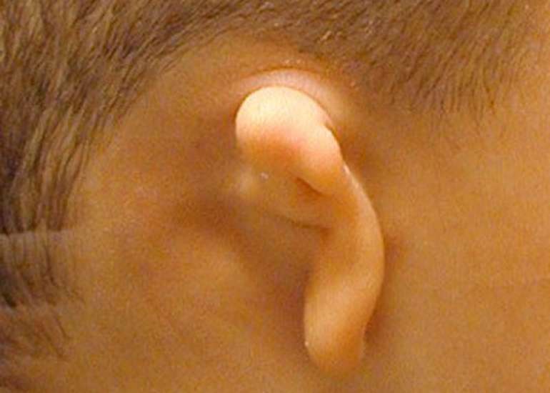 माइक्रोटिया क्या है? कारण, लक्षण और इलाज | Microtia in Hindi