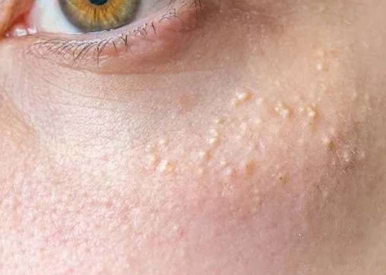 मिलिया क्या है? कारण, लक्षण और इलाज | Milia in Hindi