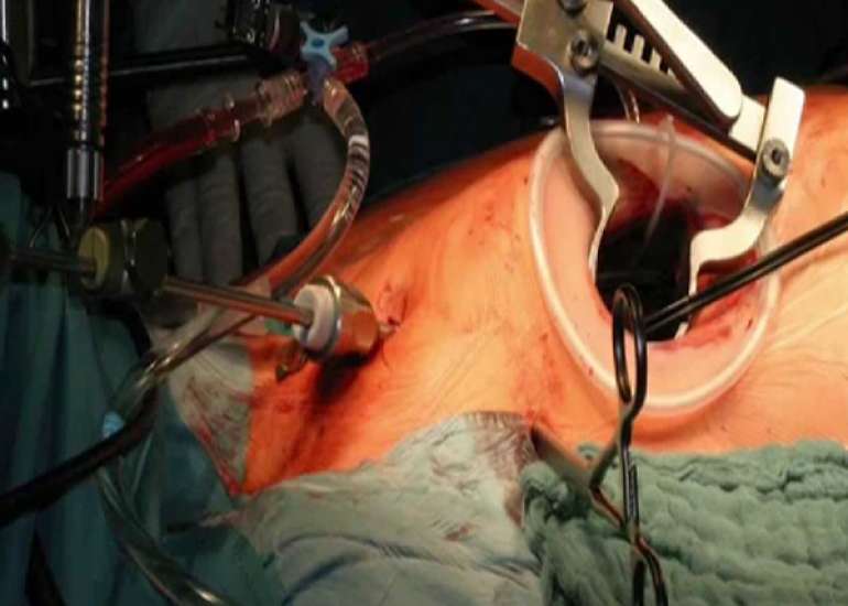 What are the indications for surgery in mitral regurgitation?