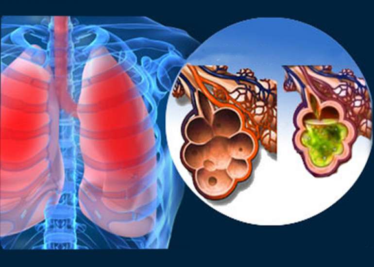 What is the management of acute respiratory distress syndrome (ARDS)?