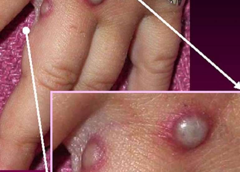 क्या है मंकीपॉक्स? कारण, लक्षण और उपचार | Monkeypox Virus in Hindi 