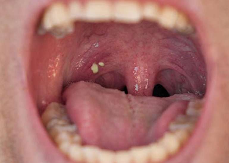 टॉन्सिलाइटिस क्या है? लक्षण, कारण, इलाज और घरेलू उपचार | Tonsils in Hindi