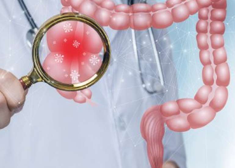 म्यूकस फिस्टुला क्या है? | Mucus Fistula in Hindi