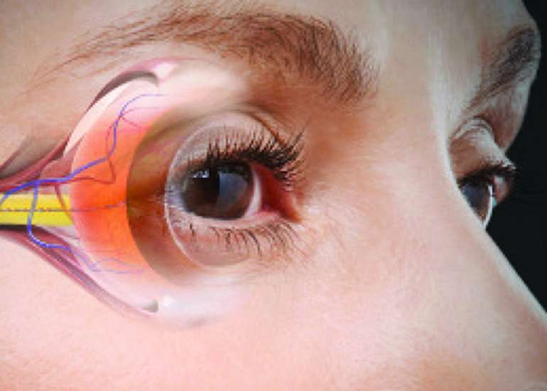 What are the medications used to treat glaucoma and are there any recent advances...?