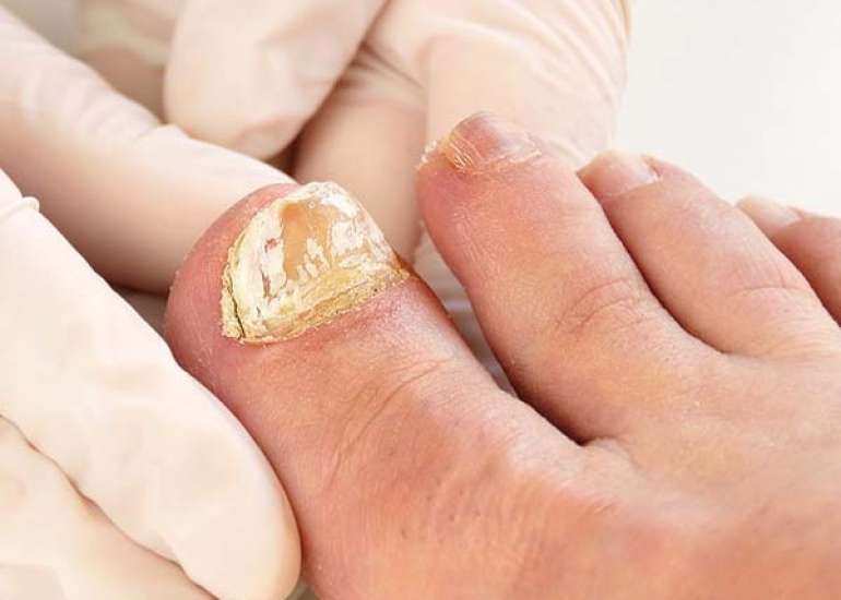 नेल फंगस क्या है? कारण लक्षण, और इलाज | Nail Fungus in Hindi