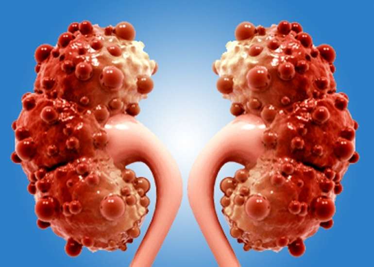 पॉलीसिस्टिक किडनी रोग क्या है? कारण, लक्षण और उपचार सब जाने | Polycystic Kidney Disease in Hindi