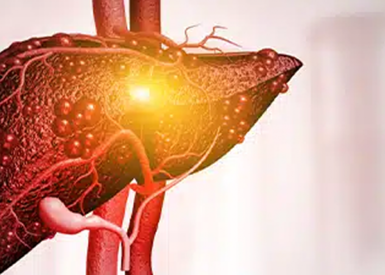 Non-alcoholic Fatty Liver Disease (NAFLD) and the Role of SGOT and SGPT in Diagnosis and Monitoring