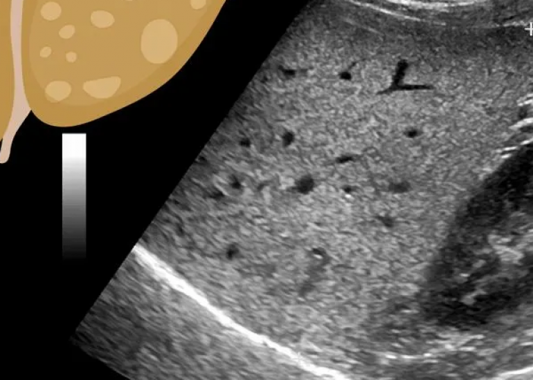 Non-Invasive Diagnostic Techniques for Liver Diseases: Current Options and Future Directions