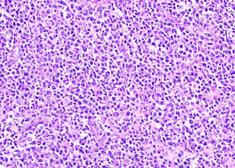 Non-Hodgkin's B-cell lymphoma of the ovary