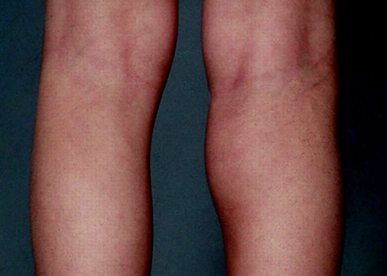 Oligoarthritis: Arthritis in Children