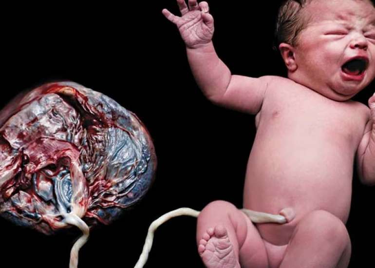 Placenta Accreta Spectrum with Ureteral Invasion