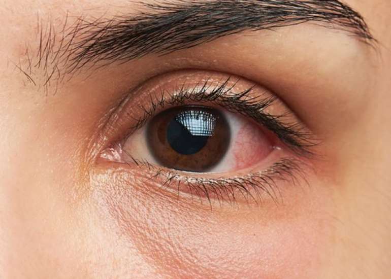 पैपिल्डेमा क्या है? कारण, लक्षण और इलाज | Papilledema in Hindi