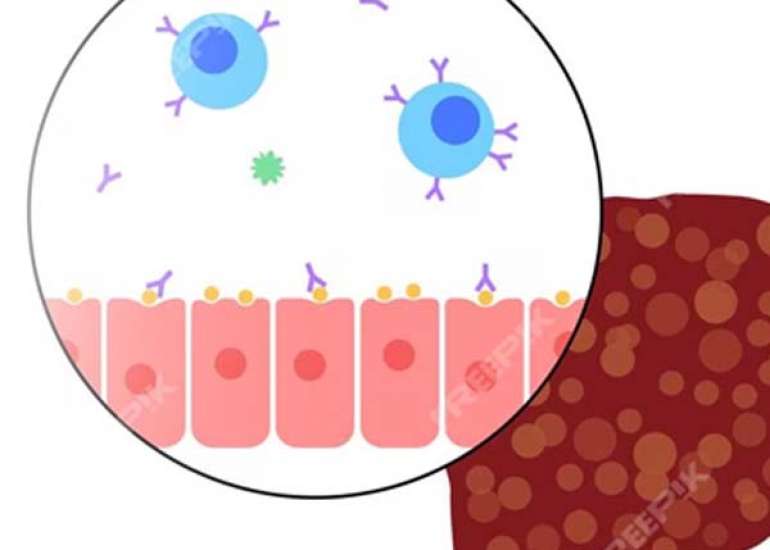 Pediatric Autoimmune Hepatitis: All you need to know