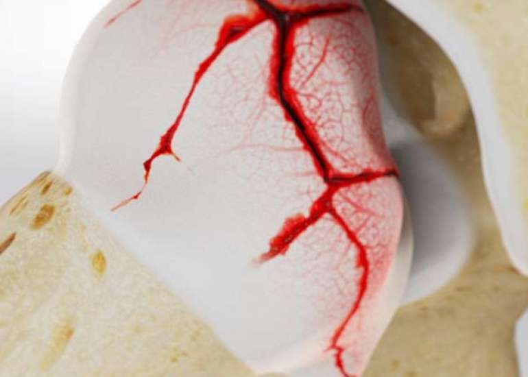 पर्थेस रोग क्या है? कारण, लक्षण और इलाज | Perthes Disease in Hindi