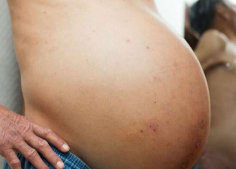 एसाइटिस क्या है? लक्षण, कारण, और इलाज | Ascites in Hindi