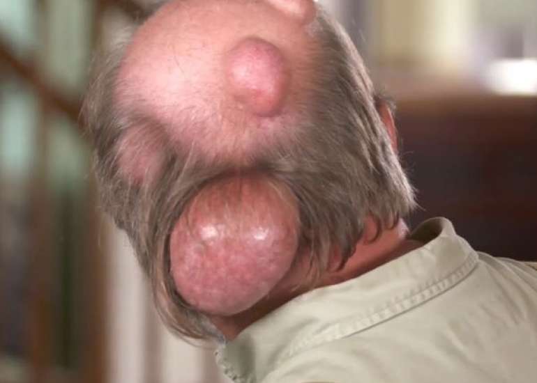 पिलर सिस्ट क्या है? कारण, लक्षण और इलाज | Pilar Cyst in Hindi