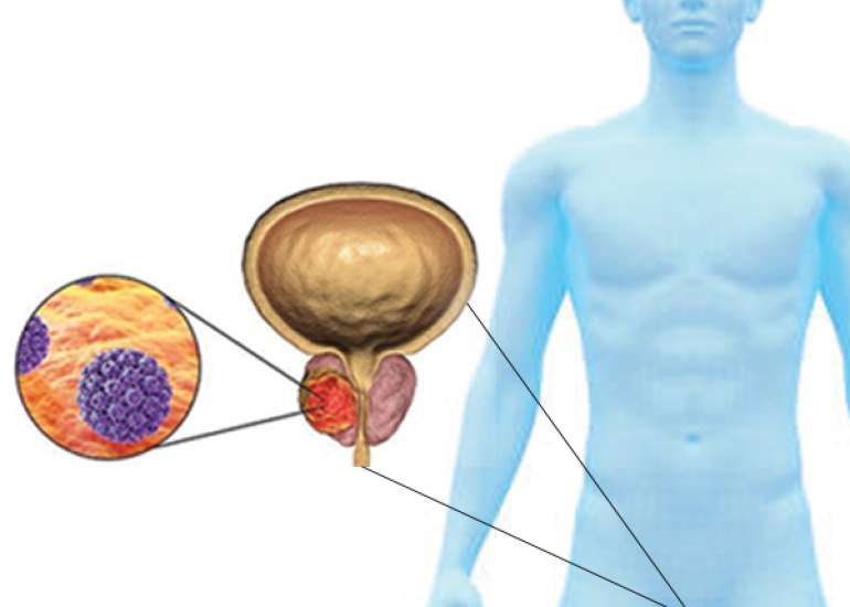प्रोस्टेट कैंसर - प्रोस्टेट कैंसर क्यों होता है, लक्षण, उपचार, दवा 