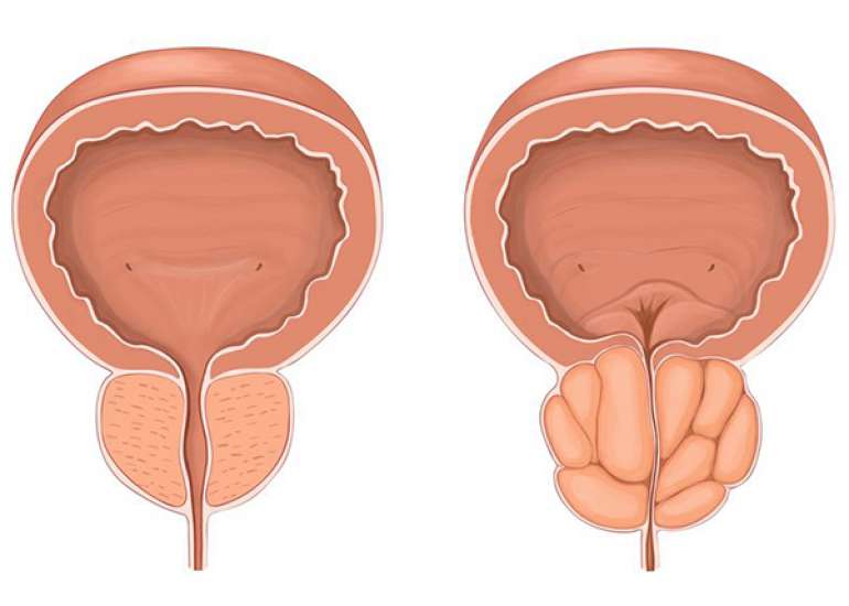Tadalafil Viagra cure prostate enlargement?