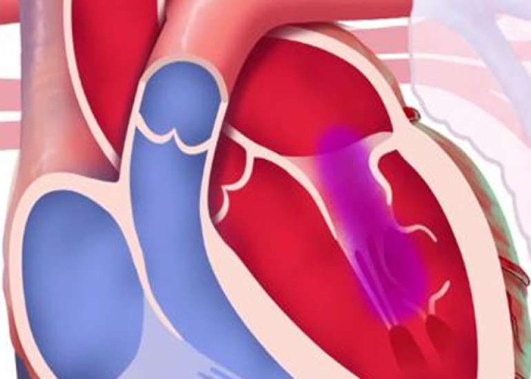 What are the indications for not intervening pure mitral stenosis?