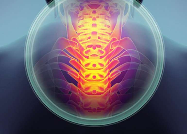 रेडिकुलोपैथी क्या है? कारण, लक्षण और इलाज | Radiculopathy in Hindi