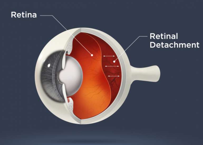 What is Retinal Detachment?