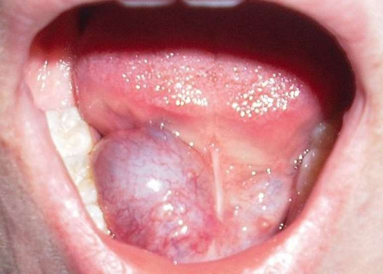 रेनुला क्या है? कारण, लक्षण और इलाज | Ranula in Hindi