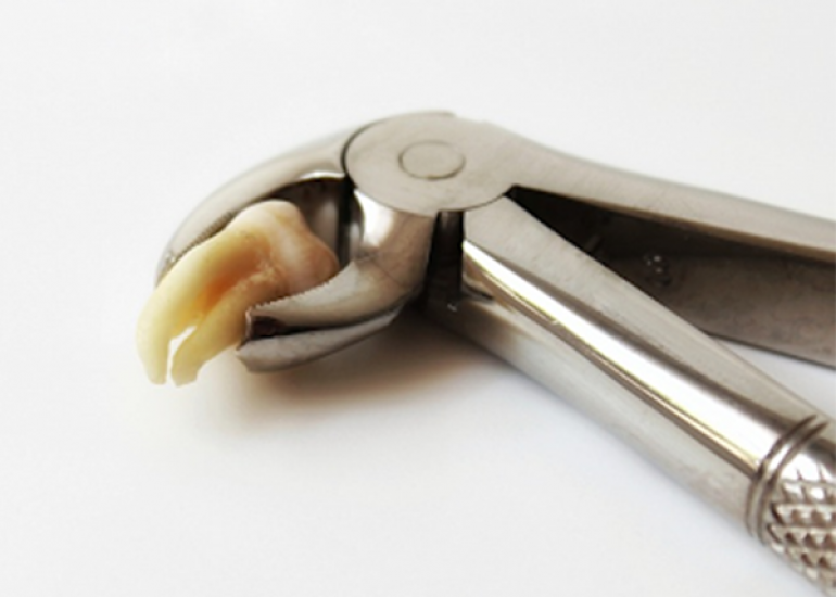 After tooth Removal Care?