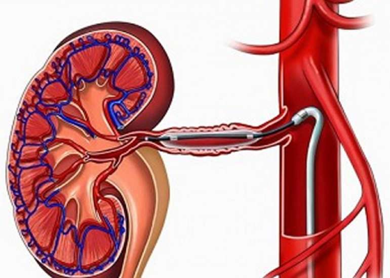 Can primary PCI be done along with renal angioplasty?