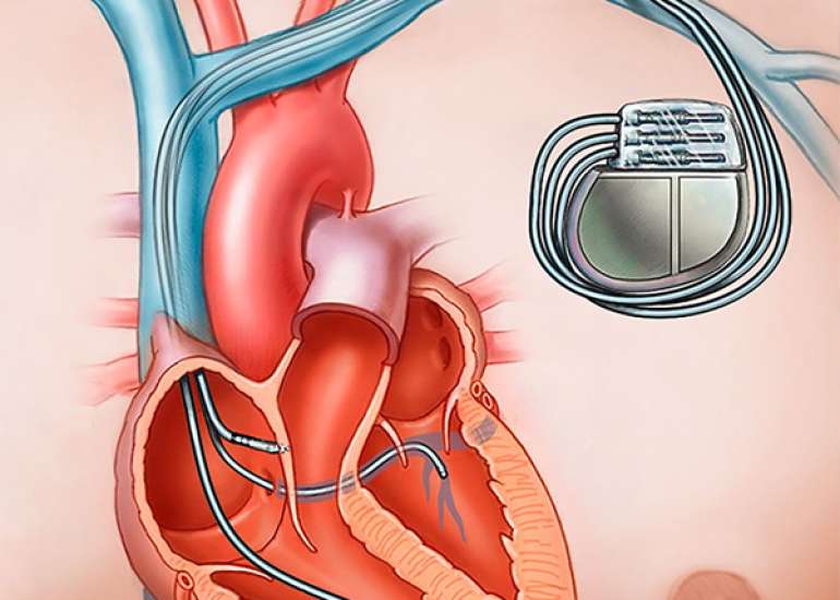 What are the reasons for pacemaker failure?