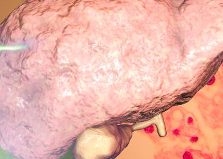 गैर-अल्कोहलिक फैटी लीवर रोग (एनएएफएलडी) में एसजीओटी और एसजीपीटी की भूमिका : निदान और निगरानी