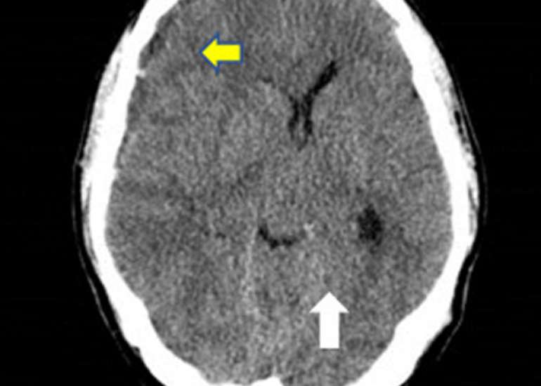 Recurrent bleeding in a healthy child – A case of lupus anticoagulant-hypoprothrombinemia syndrome