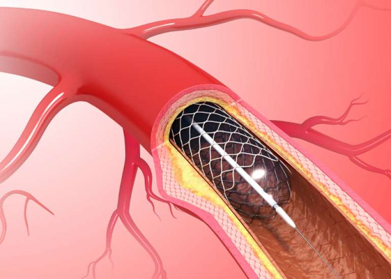 What are the second generation stents?