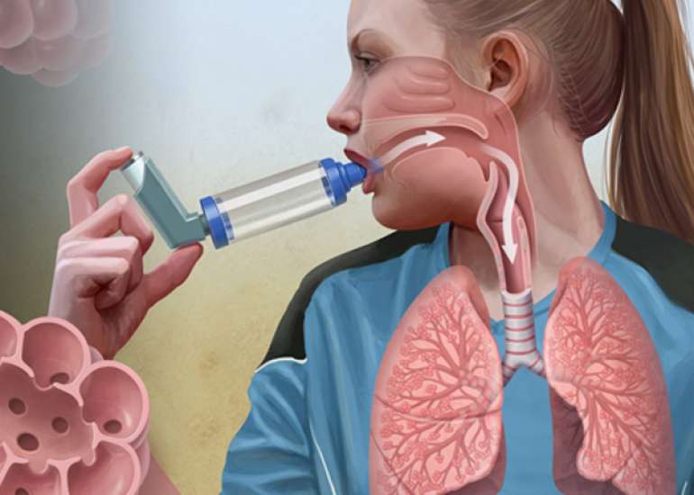 What is the formula of two to classify the severity of asthma?