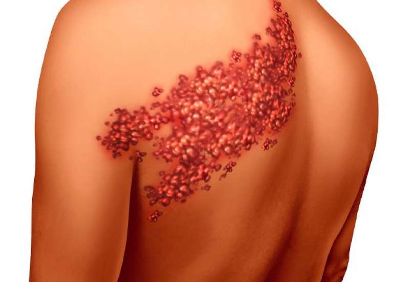 शिंगल्स क्या है? कारण, लक्षण और इलाज | Shingles in Hindi