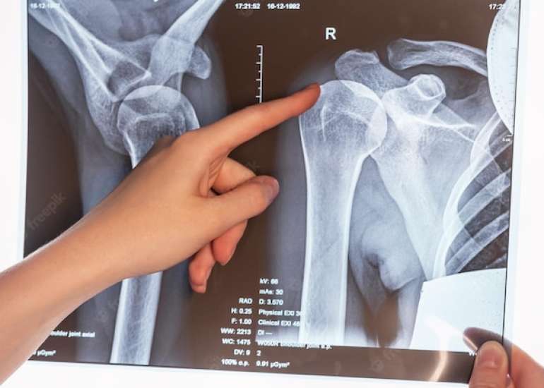कंधे का एक्स-रे क्यों और कैसे किया जाता है?| Shoulder X-ray in Hindi 