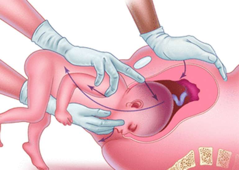 Shiralee's Revised Version of the Modified MSV Maneuver for Dealing with the Aftercoming Head of a Breech Presentation