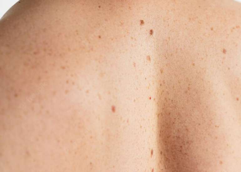 स्किन बायोप्सी क्या है?| Skin Biopsy in Hindi