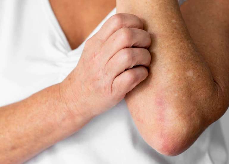 एलर्जी परीक्षण क्या है? | Allergy Test in Hindi