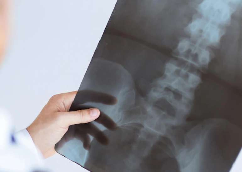 स्पाइन एक्स-रे क्या है? | Spine X-ray in Hindi