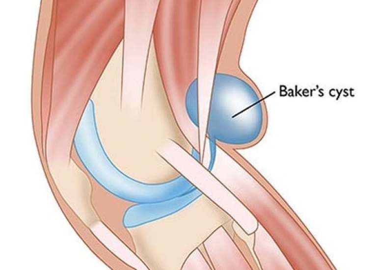 बेकर्स सिस्ट क्या है? कारण, लक्षण और उपचार 