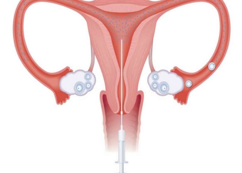 What is the success rate of IUI?